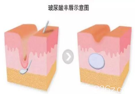 玻尿酸豐唇圖解