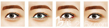 開外眼角手術(shù)過程圖