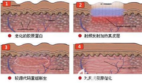 射頻緊膚操作過(guò)程原理