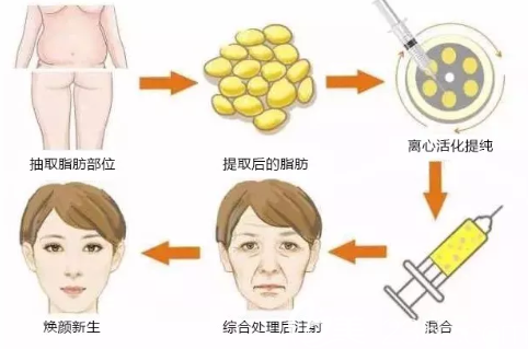 自體脂肪面部填充過(guò)程圖解