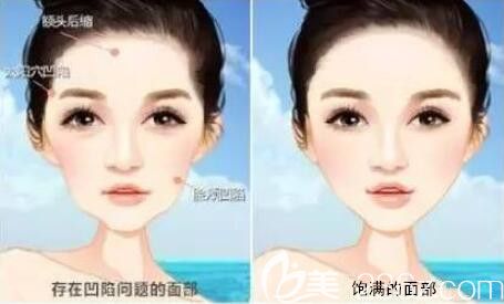 面部脂肪填充解決面部凹陷問(wèn)題