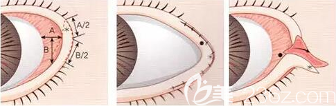 開外眼角手術(shù)過程圖
