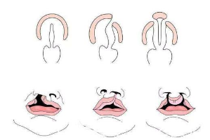 唇腭裂手術示意圖