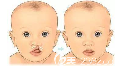 唇腭裂嬰兒