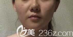 法令紋深重的自己求問(wèn)注射玻尿酸后能保持多久 法令紋深重的自己求問(wèn)注射玻尿酸后能保持多久