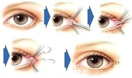  開外眼角容易引起結(jié)膜刺激