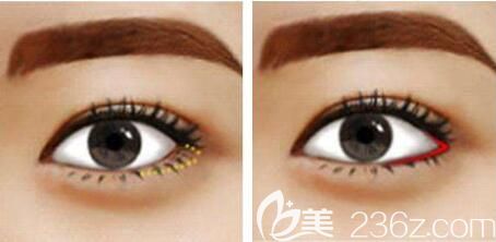 開外眼角適用范圍小