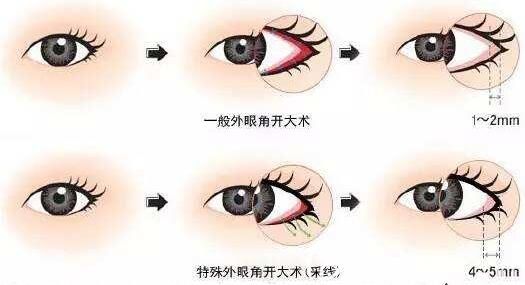開完眼角容易造成眼球突出
