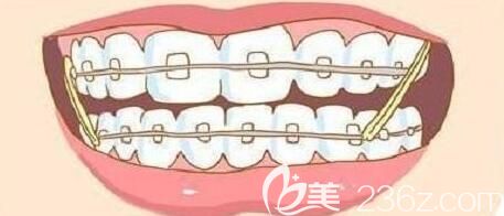 維樂陽(yáng)光口腔楊唐文醫(yī)生介紹錯(cuò)頜畸形的矯治方法