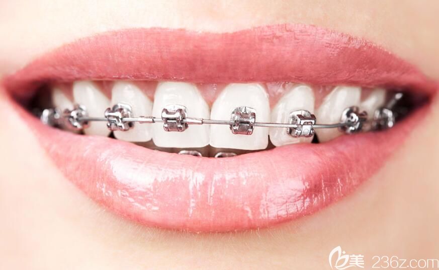 上饒維樂陽光口腔楊凡醫(yī)生說牙齒矯正要趁早