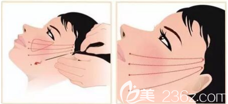 埋線提升手術(shù)示意圖