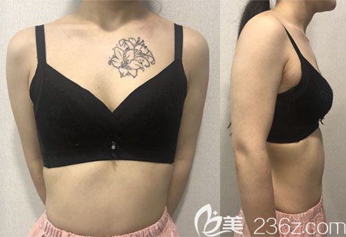 韓國普羅菲耳蓓拉假體隆胸真人案例