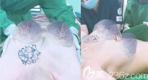 韓國普羅菲耳隆胸手術(shù)過程中