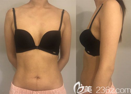 韓國普羅菲耳魔笛假體隆胸案例