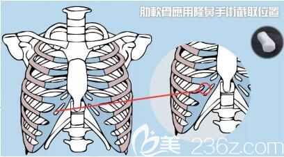 肋軟骨隆鼻術(shù)后效果自然嗎？