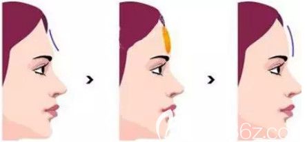 脂肪填充額頭手術(shù)3--6個(gè)月恢復(fù)自然