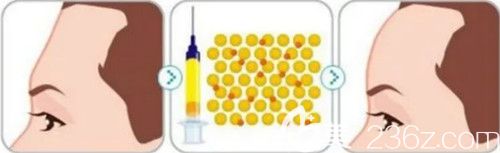 自體脂肪豐額頭手術(shù)前后對比