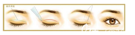 全切雙眼皮手術(shù)流程
