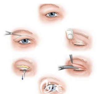 全切雙眼皮手術(shù)示意圖