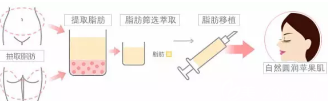 自體脂肪填充蘋果肌手術(shù)過程圖