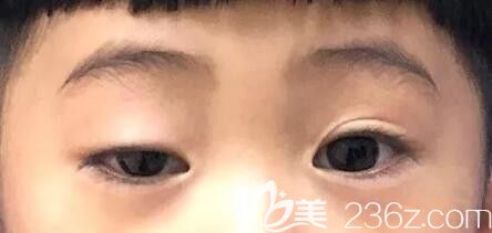 上瞼提肌術(shù)后效果