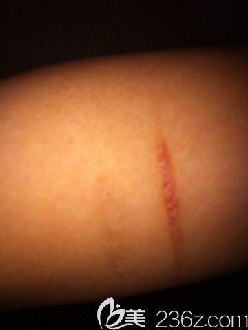 5厘米左右的陳舊疤痕 5厘米左右的陳舊疤痕
