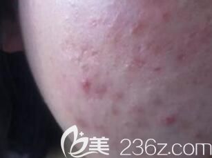 光子嫩膚和微針哪個(gè)祛痘印痘坑效果好？