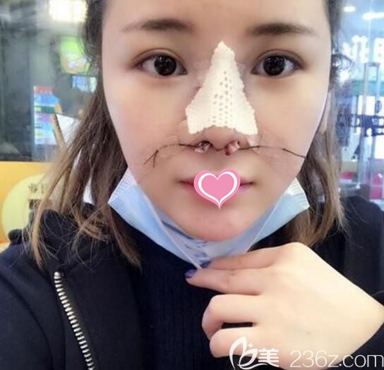 韓國(guó)清潭first鼻修復(fù)術(shù)后第2天真實(shí)照片 韓國(guó)清潭first鼻修復(fù)術(shù)后第2天真實(shí)照片