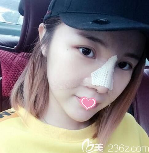 韓國(guó)清潭first整形外科醫(yī)院鼻修復(fù)術(shù)后3天恢復(fù)照片 韓國(guó)清潭first整形外科醫(yī)院鼻修復(fù)術(shù)后3天恢復(fù)照片