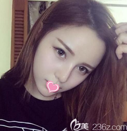 韓國(guó)清潭first醫(yī)院鼻修復(fù)術(shù)后15天 韓國(guó)清潭first醫(yī)院鼻修復(fù)術(shù)后15天