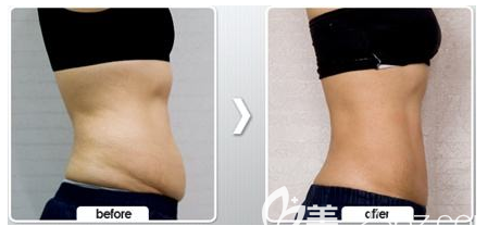 腰腹吸脂對(duì)比照片