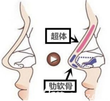半肋軟骨隆鼻示意圖