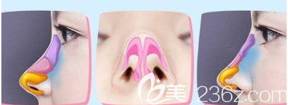 半肋軟骨隆鼻的情況