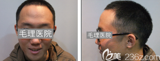 韓國植發(fā)際線多少錢？韓國毛理醫(yī)院發(fā)際線種植價(jià)格優(yōu)惠，看下小哥哥植發(fā)術(shù)后6個(gè)月恢復(fù)圖