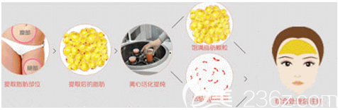 自體脂肪豐額頭手術(shù)過程圖