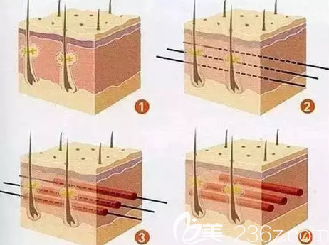 修護(hù)損傷的皮下組織