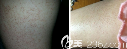 毛周角化病 毛周角化病