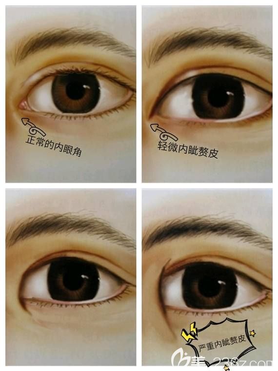 內(nèi)眥贅皮的幾種情況分類 內(nèi)眥贅皮的幾種情況分類