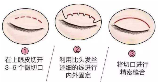 上海愉悅美聯(lián)臣醫(yī)療美容醫(yī)院陳紅梅切開雙眼皮