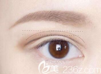 做完全切雙眼皮后的緊繃感多久會消失？