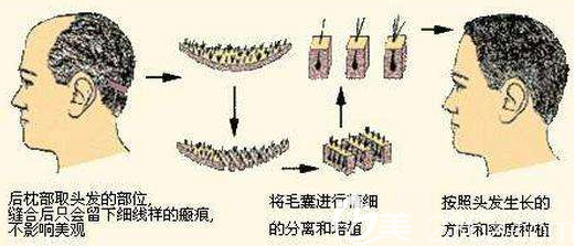 上海愉悅美聯(lián)臣醫(yī)療美容醫(yī)院孫永剛毛發(fā)種植