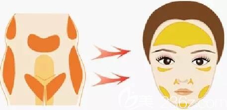 自體脂肪移植填充面部位置