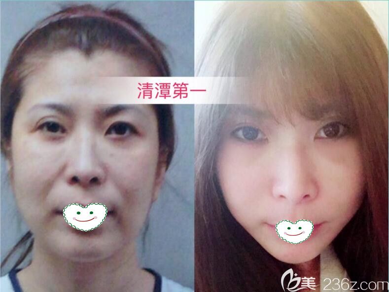 韓國清潭first整形外科縱深肌理歸位術(shù)提升案例