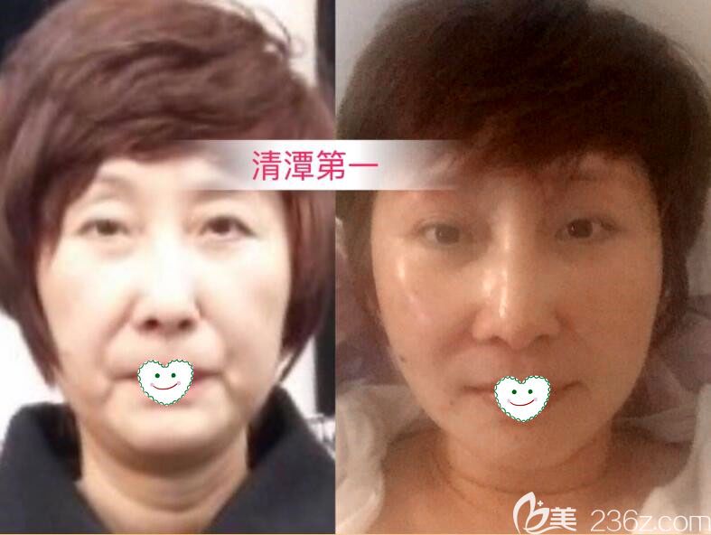 在韓國清潭first做小切口面部提升術(shù)前后效果對比圖