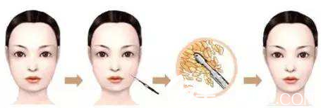 面部吸脂對(duì)比照