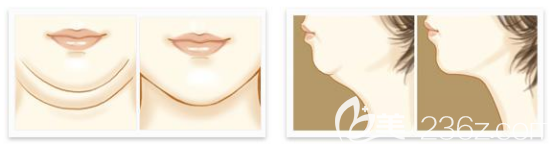 面部吸脂對(duì)比圖片