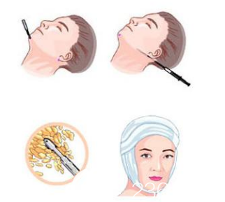 面部吸脂手術(shù)示意圖