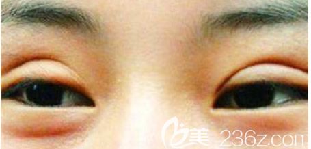埋線雙眼皮不對稱 埋線雙眼皮不對稱