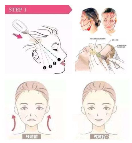 尹延喜醫(yī)生做面部線雕提升手術過程