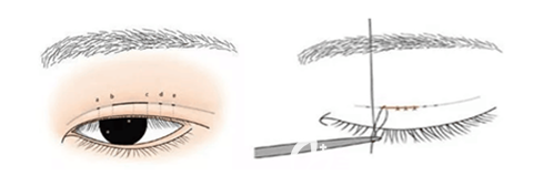 東方藝整形雙眼皮疤痕修復